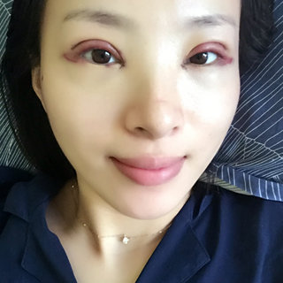 变美需要勇气,双眼皮手术恢复日记